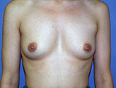 Patient # 40255 Before Photo # 1